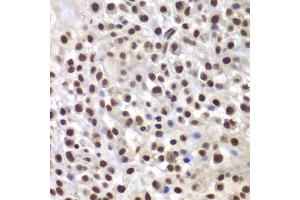 Immunohistochemistry of paraffin-embedded mouse cancer using SMARCB1 antibody (ABIN5973389) at dilution of 1/200 (40x lens). (SMARCB1 抗体)