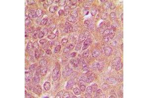 Immunohistochemical analysis of TPH1 staining in human breast cancer formalin fixed paraffin embedded tissue section. (Tryptophan Hydroxylase 1 抗体)