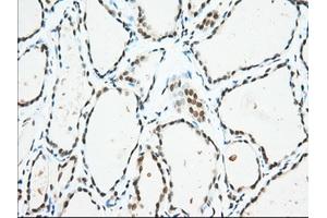 Immunohistochemical staining of paraffin-embedded Adenocarcinoma of Human colon tissue using anti-USP5 mouse monoclonal antibody. (USP5 抗体)