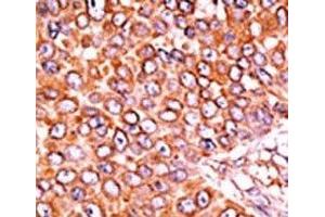 IHC analysis of FFPE human breast carcinoma tissue stained with the phospho-p27Kip1 antibody. (CDKN1B 抗体  (pThr157))