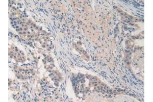 IHC-P analysis of Human Lung Cancer Tissue, with DAB staining. (MMP19 抗体  (AA 98-508))