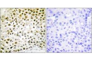 Immunohistochemistry analysis of paraffin-embedded human breast carcinoma tissue, using Histone H2B (Ab-15) Antibody. (Histone H2B 抗体  (AA 11-60))