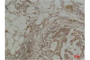 Immunohistochemistry (IHC) analysis of paraffin-embedded Human Breast Carcinoma using Pan Methylated Lysine Monoclonal Antibody. (Methylated Lysine (pan) 抗体)