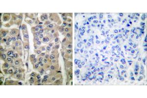 Peptide - +Immunohistochemical analysis of paraffin-embedded human breast carcinoma tissue using Involucrin antibody (#C0236). (Involucrin 抗体)