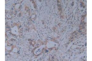 IHC-P analysis of Human Pancreas Cancer Tissue, with DAB staining. (Fibrillin 1 抗体  (AA 246-389))