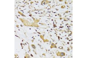 Immunohistochemistry of paraffin-embedded human liver cancer using GPD2 Antibody (ABIN5973974) at dilution of 1/100 (40x lens). (GPD2 抗体)