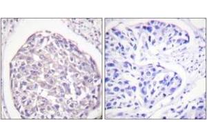 Immunohistochemistry analysis of paraffin-embedded human breast carcinoma, using IR (Phospho-Tyr1355) Antibody. (IR (AA 1326-1375), (pTyr1355) 抗体)