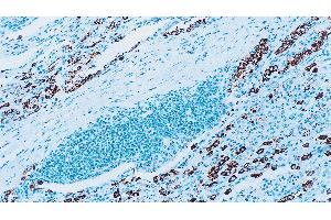 Human lung adenocarcinoma: immunohistochemical staining for Surfactant Protein A. (Surfactant Protein A1 抗体)