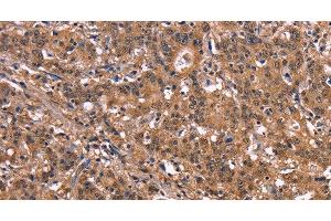 Immunohistochemistry of paraffin-embedded Human liver cancer tissue using NOS2 Polyclonal Antibody at dilution 1:40 (NOS2 抗体)