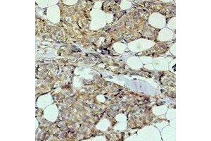 Immunohistochemical analysis of HER2 staining in human breast cancer formalin fixed paraffin embedded tissue section. (ErbB2/Her2 抗体)