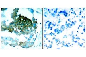 Immunohistochemical analysis of paraffin-embedded human lung carcinoma tissue, using PKCθ (Ab-695) antibody (E021185). (PKC theta 抗体)