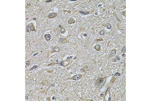 Immunohistochemistry of paraffin-embedded human brain cancer using WIPI1 Antibody (ABIN2560779) at dilution of 1:100 (40x lens). (WIPI1 抗体)