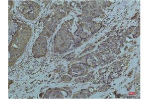 Immunohistochemistry (IHC) analysis of paraffin-embedded Human Breast Carcicnoma using GRP78/Bip Mouse Monoclonal Antibody diluted at 1:200. (GRP78 抗体)