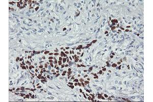 Immunohistochemical staining of paraffin-embedded Carcinoma of Human lung tissue using anti-TP53 mouse monoclonal antibody. (p53 抗体)