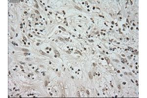 Immunohistochemical staining of paraffin-embedded Carcinoma of kidney tissue using anti-BUB1Bmouse monoclonal antibody. (BUB1B 抗体)