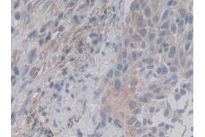 Detection of RALA in Human Lung cancer Tissue using Monoclonal Antibody to V-Ral Simian Leukemia Viral Oncogene Homolog A (RALA) (rala 抗体  (AA 1-206))