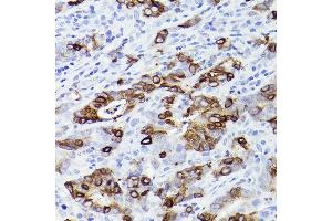 Immunohistochemistry of paraffin-embedded human colon carcinoma using TFF3 Rabbit mAb (ABIN1680916, ABIN3019077, ABIN3019078 and ABIN7101711) at dilution of 1:100 (40x lens). (TFF3 抗体)