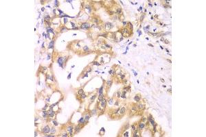 Immunohistochemistry of paraffin-embedded human liver cancer using ACADS antibody (ABIN5970342) at dilution of 1/100 (40x lens). (ACADS 抗体)