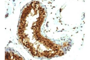 Formalin-fixed, paraffin-embedded human Testicular Carcinoma stained with SUMO-1 Monoclonal Antibody (SUMO1/1188) (SUMO1 抗体)