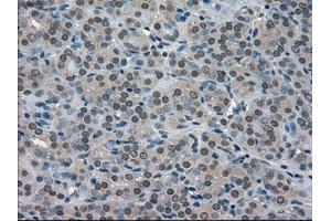 Immunohistochemical staining of paraffin-embedded Adenocarcinoma of ovary tissue using anti-SOD1mouse monoclonal antibody. (SOD1 抗体)