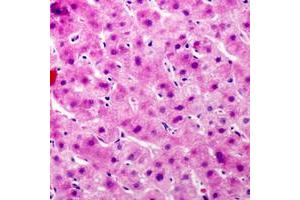 Immunohistochemical analysis of Complement C9 staining in human liver cancer formalin fixed paraffin embedded tissue section. (C9 抗体  (Center))