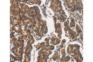 Immunohistochemistry of Human breast cancer using ITGA2 Polyclonal Antibody at dilution of 1:30 (ITGA2 抗体)