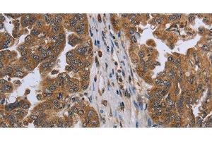 Immunohistochemistry of paraffin-embedded Human ovarian cancer using NDUFAF4 Polyclonal Antibody at dilution of 1:45 (NDUFAF4 抗体)
