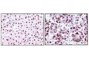 Immunohistochemical analysis of paraffin-embedded human liver carcinoma tissues, showing nuclear localization using NPM antibody with DAB staining. (NPM1 抗体)