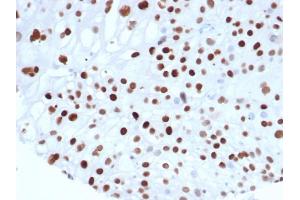 Formalin fixed paraffin embedded human colon carcinoma stained with p21 Recombinant Mouse Monoclonal Antibody (rCIP1/6907) at 2 μg/mL. (Recombinant p21 抗体  (AA 1-100))