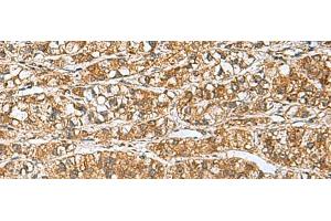 Immunohistochemistry of paraffin-embedded Human liver cancer tissue using GINS3 Polyclonal Antibody at dilution of 1:60(x200) (GINS3 抗体)