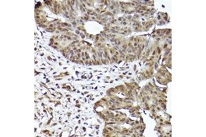 Immunohistochemistry of paraffin-embedded human colon carcinoma using [KO Validated] ST Rabbit mAb (ABIN7270305) at dilution of 1:100 (40x lens). (STAT3 抗体)