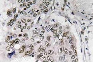 Immunohistochemistry (IHC) analyzes of Smad6 antibody in paraffin-embedded human lung carcinoma tissue. (SMAD6 抗体)