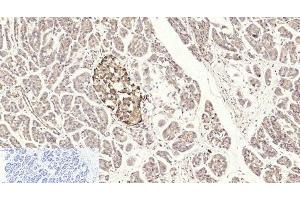 Immunohistochemistry of paraffin-embedded Human stomach cancer tissue using Cleaved-CASP3 p17 (D175) Polyclonal Antibody at dilution of 1:200. (Caspase 3 p17 (Cleaved-Asp175) 抗体)