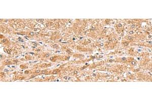 Immunohistochemistry of paraffin-embedded Human liver cancer tissue using HMGCLL1 Polyclonal Antibody at dilution of 1:70(x200) (HMGCLL1 抗体)