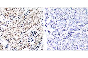P-Peptide - +Immunohistochemical analysis of paraffin-embedded human breast carcinoma tissue using Chk1 (phospho-Ser345) antibody. (CHEK1 抗体  (pSer345))