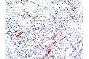 Immunohistochemical analysis of paraffin-embedded Human Breast Carcinoma Tissue using TGFβ1 Mouse mAb diluted at 1:200. (TGFB1 抗体)