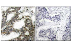 Immunohistochemical analysis of paraffin-embedded human breast carcinoma tissue, using β-Catenin (Ab-33) antibody (E021211). (beta Catenin 抗体)