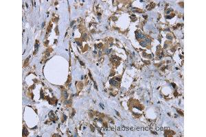 Immunohistochemistry of Human breast cancer using MYL12B Polyclonal Antibody at dilution of 1:20 (MYL12B 抗体)