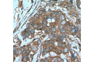 IHC analysis of paraffin-embedded human breast cancer tissue using Beclin 1 antibody at a dilution of 1:200. (Beclin 1 抗体)
