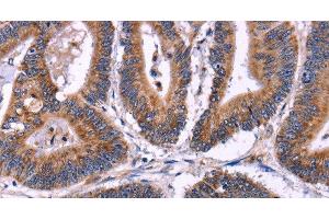 Immunohistochemistry of paraffin-embedded Human colon cancer using SIGLEC5 Polyclonal Antibody at dilution of 1:30 (SIGLEC5 抗体)