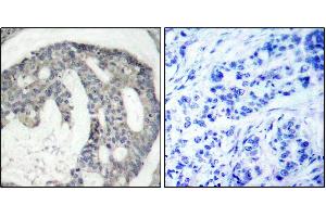 Immunohistochemistry of paraffin-embedded human breast carcinoma using Phospho-NOS3-S1177 antibody (ABIN2988223). (ENOS 抗体  (pSer1177))