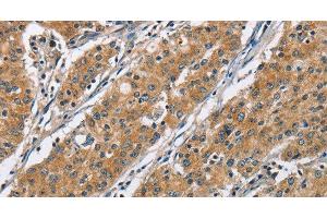 Immunohistochemistry of paraffin-embedded Human gastric cancer using COPB1 Polyclonal Antibody at dilution of 1:50 (COPB1 抗体)