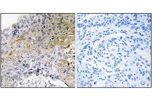 Immunohistochemical analysis of paraffin-embedded human breast carcinoma tissue using p130 Cas (Ab-410) antibody. (BCAR1 抗体)