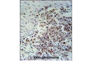 XRCC1 Antibody (Center) (ABIN651735 and ABIN2840381) immunohistochemistry analysis in formalin fixed and paraffin embedded human skin carcinoma followed by peroxidase conjugation of the secondary antibody and DAB staining. (XRCC1 抗体  (AA 407-435))