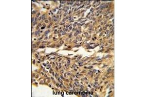 Formalin-fixed and paraffin-embedded human lung carcinoma reacted with EXOC5 Antibody (C-term), which was peroxidase-conjugated to the secondary antibody, followed by DAB staining. (EXOC5 抗体  (C-Term))