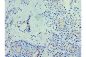 Immunohistochemistry of paraffin-embedded human breast cancer using ABIN7163439 at dilution of 1:100 (PHYH 抗体  (AA 1-338))