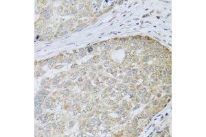 Immunohistochemistry of paraffin-embedded human liver cancer using ANAPC10 antibody. (ANAPC10 抗体  (AA 1-185))