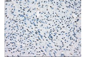 Immunohistochemical staining of paraffin-embedded Adenocarcinoma of colon tissue using anti-FCGR2A mouse monoclonal antibody. (FCGR2A 抗体)