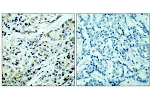 Immunohistochemical analysis of paraffin-embedded human breast carcinoma tissue, using HDAC5 (phospho-Ser498) antibody (E011193). (HDAC5 抗体  (pSer498))