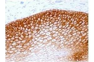 Formalin-fixed, paraffin-embedded human Cervical Squamous Cell Carcinoma stained withCD44v4 Mouse Recombinant Monoclonal Antibody (rCD44v4/1219). (Recombinant CD44 抗体)